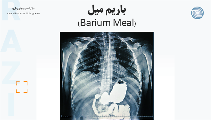 رادیولوژی باریم میل (Barium Meal) برای بررسی معده و اثنی عشر