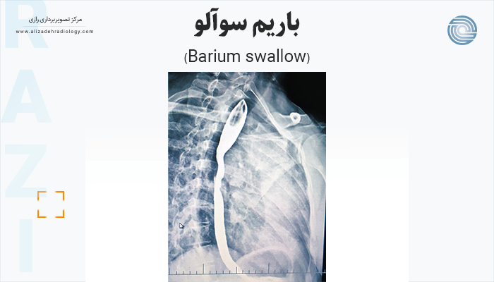 رادیولوژی باریم سوآلو(Barium swallow) برای بررسی حلق و مری